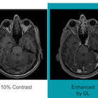 #RSNA18: AI may help reduce MRI gadolinium dose #RSNA18: AI may help reduce MRI gadolinium dose