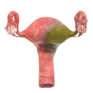 #SIR2019: UFE safer than surgery for women #SIR2019: UFE safer than surgery for women