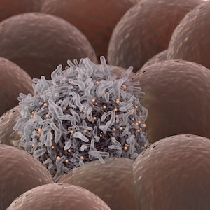 U.S. dense breast notification laws: awareness & early cancer detection after mammo U.S. dense breast notification laws: awareness & early cancer detection after mammo