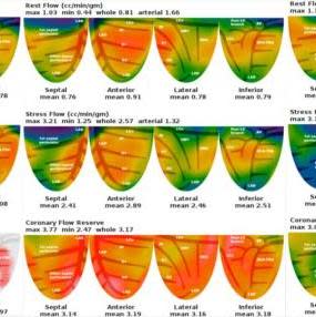 Moderate OSA in a 49-year-old male Moderate OSA in a 49-year-old male