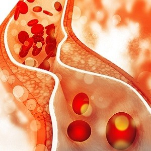 #ESCCongress: Findings from the EVOPACS Study #ESCCongress: Findings from the EVOPACS Study