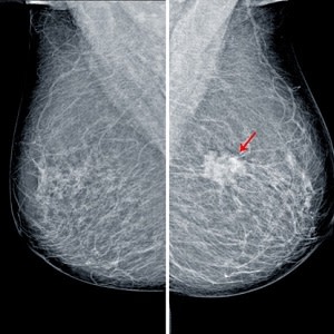 乳房成像興趣放射學學員什麼？