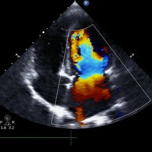 Heart Ultrasound Determines Dementia Risk Heart Ultrasound Determines Dementia Risk