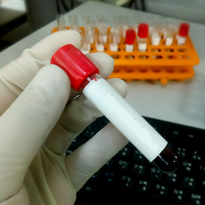 Accuracy of Pancreatic Stone Protein for Diagnosis of Infection Accuracy of Pancreatic Stone Protein for Diagnosis of Infection