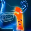 Medical illustration highlighting the throat and neck region, with emphasised tissue changes along the pharynx.