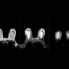 Breast MRI scan showing detailed breast tissue imaging for radiology assessment, cancer detection and diagnostic review.