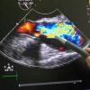 Cardiac ultrasound with Doppler flow imaging, supporting echocardiography, heart valve assessment, cardiovascular diagnostics and clinical decision-making.