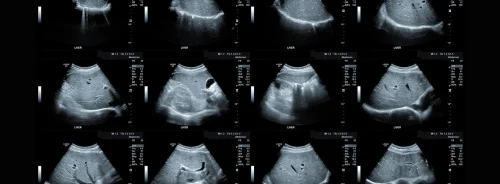 Multipanel abdominal ultrasound scans of the liver in different views. 
