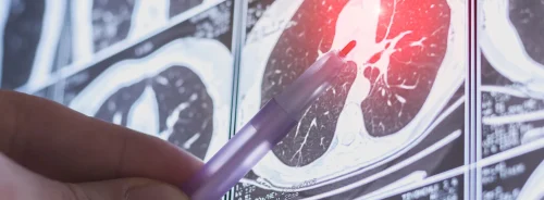 Doctor pointing at highlighted abnormality on lung CT scan. 