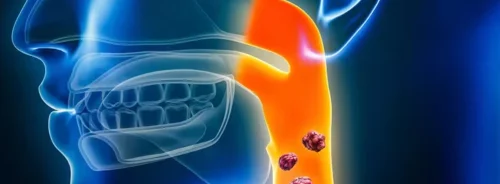 Medical illustration highlighting the throat and neck region, with emphasised tissue changes along the pharynx.