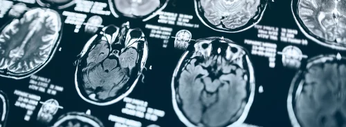 Brain MRI scan images displaying multiple views for neurological diagnosis and clinical assessment.