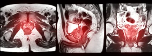 Composite medical image showing multi-planar MRI views of the pelvic region, with axial, sagittal and coronal perspectives highlighting soft-tissue anatomy.