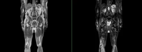 Full-body MRI comparison scans in two views.