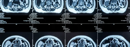 A grid of abdominal MRI slices displayed on a radiology screen.
