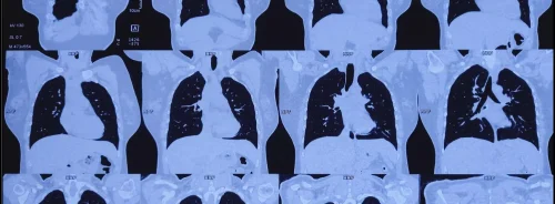 Thoracic CT scan series illustrating detailed lung imaging for diagnostic evaluation and disease assessment.