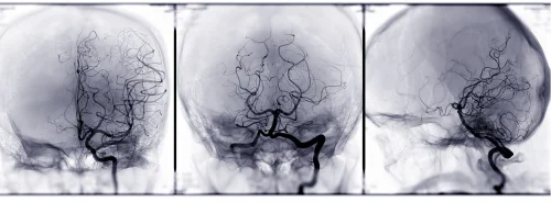 Cerebral angiography scan showing blood vessels in the brain for vascular imaging, stroke assessment and neurovascular diagnosis.