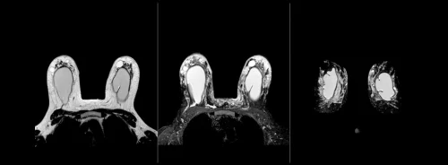 Breast MRI scan showing detailed breast tissue imaging for radiology assessment, cancer detection and diagnostic review.