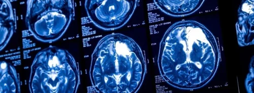 Brain MRI scans for neurological assessment, supporting diagnostic imaging, neuroimaging analysis and clinical care planning.