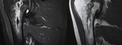 Shoulder MRI scan showing humeral head and joint anatomy, supporting musculoskeletal imaging, orthopaedic assessment and clinical care planning.