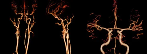 Cerebral angiography reconstructions, supporting neurovascular imaging, stroke assessment, vascular planning and diagnostic review.