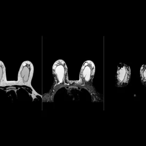 Breast MRI scan showing detailed breast tissue imaging for radiology assessment, cancer detection and diagnostic review.