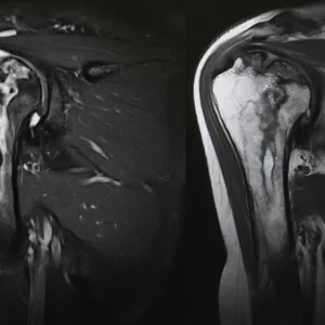 Shoulder MRI scan showing humeral head and joint anatomy, supporting musculoskeletal imaging, orthopaedic assessment and clinical care planning.