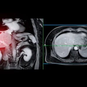 Abdominal MRI scan with highlighted liver area, supporting hepatic lesion assessment, radiology diagnosis and hepatology care planning.