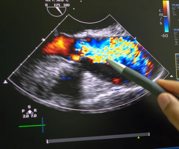 Cardiac ultrasound with Doppler flow imaging, supporting echocardiography, heart valve assessment, cardiovascular diagnostics and clinical decision-making.