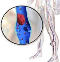 Deep vein thrombosis