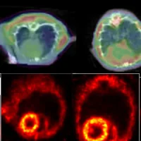 A PET scan detects clumping proteins in rat hearts (top). The enlarged heart (right) is one with heart failure. Other PET scans showing blood flow in the rat hearts (bottom) show that the protein clumps aren't due to circulation problems.