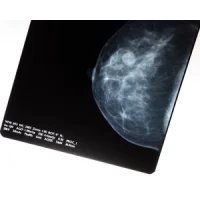 20% Increase in Breast Cancer Detection with AI-Supported Mammogram Screening