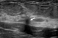 Assessment of Cancer Upstaging Risk in Radial Scars