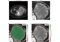 Renal Tumour Segmentation: AI Enhances Detection and Treatment Planning