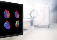 Role of AI in Enhancing Coronary Calcium Scoring