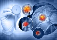 Radiologic Factors Influencing Rapid Growth in Early-Stage HCC