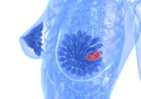 18F-FDG vs 18F-FES PET for Staging Low-Grade ER-Positive Breast Cancer