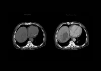 CT scan comparison showing liver in non-contrast and portal venous phases for tumour detection 