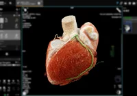 3D cardiac CT scan showing detailed heart anatomy and coronary artery visualisation 