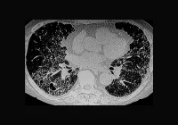 Chest CT scan showing bilateral pulmonary fibrosis with honeycombing, indicative of interstitial lung disease. 