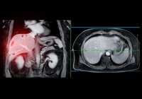 Abdominal MRI highlighting liver region for diagnostic imaging of tumours, lesions or liver disease evaluation 