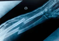 X-ray image showing a fractured forearm with clear break in the radius bone near the wrist joint. 