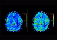 Perfusion MRI brain scans showing cerebral blood flow and volume maps for stroke or tumour assessment using colour-coded imaging. 