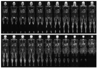 Whole-body MRI scan showing coronal slices for comprehensive diagnostic imaging and oncology staging. 