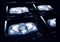 CT scan showing cross-sectional pelvic imaging for diagnostic evaluation