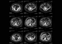 Abdominal CT scan cross-sectional images showing internal organs for diagnostic evaluation 