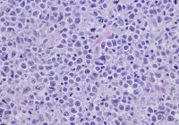 Microscopic image of lymphoma tissue showing abnormal lymphocyte cells for cancer diagnosis 