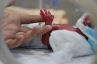 SCAI: Transcatheter Occlusion of Patent Ductus Arteriosus in Premature Infants