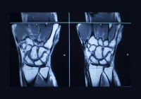 MRI scan of human wrist joint showing carpal bone anatomy for injury evaluation 
