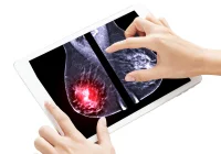  Digital mammogram on tablet highlighting dense breast tissue, illustrating AI-assisted assessment in radiology. 