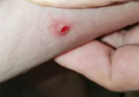 Why Pressure Ulcers Signal a Breakdown in Healthcare Management
